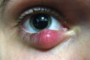 chalazion